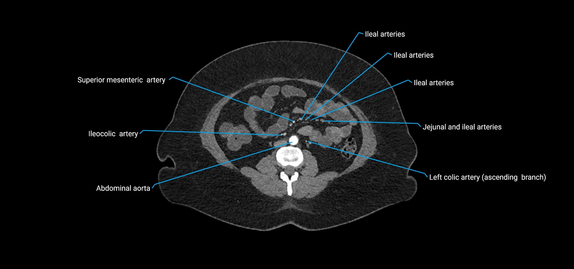 CTA abdomen axial cross sectional anatomy labelled image_107 (2).webp